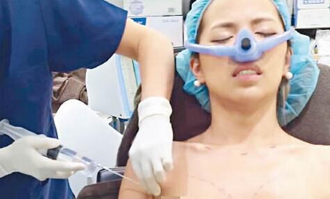 詩曼芬：島國(guó)的“灰姑娘隆胸法”，真的無副作用嗎?